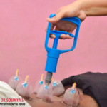 Cupping Therapy at Dr. Soumya's Physiotherapy Clinic